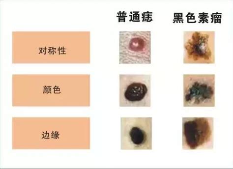 懷孕長痣|【懷孕長痣】懷孕長痣？別慌！中西醫聯手教你輕鬆擺脱痘疤、斑。